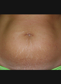 Stretch-Mark-before-3 Houston Wellness & Aesthetics|Before and After Gallery