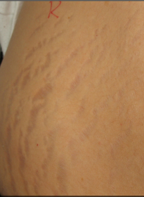 Stretch-Mark-before-4 Houston Wellness & Aesthetics|Before and After Gallery