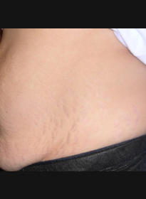 Stretch-Mark-before Houston Wellness & Aesthetics|Before and After Gallery