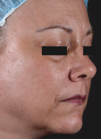 ThreeForMe-after-2 Houston Wellness & Aesthetics|Before and After Gallery