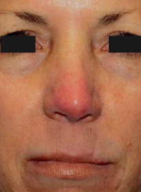 ThreeForMe-after-4 Houston Wellness & Aesthetics|Before and After Gallery