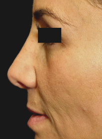 ThreeForMe-after-5 Houston Wellness & Aesthetics|Before and After Gallery