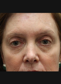 ThreeForMe-after-6 Houston Wellness & Aesthetics|Before and After Gallery