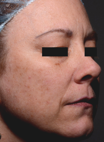 ThreeForMe-before-2 Houston Wellness & Aesthetics|Before and After Gallery