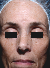 ThreeForMe-before-3 Houston Wellness & Aesthetics|Before and After Gallery