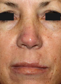 ThreeForMe-before-4 Houston Wellness & Aesthetics|Before and After Gallery