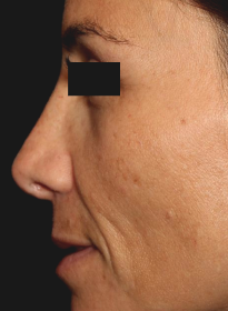 ThreeForMe-before-5 Houston Wellness & Aesthetics|Before and After Gallery