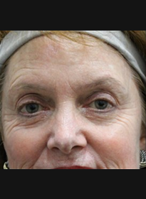 ThreeForMe-before-6 Houston Wellness & Aesthetics|Before and After Gallery