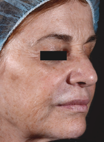 ThreeForMe-before Houston Wellness & Aesthetics|Before and After Gallery