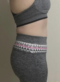 Weight-Loss-after-3 Houston Wellness & Aesthetics|Before and After Gallery