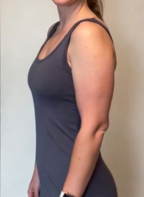 Weight-Loss-after Houston Wellness & Aesthetics|Before and After Gallery
