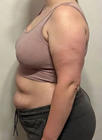 Weight-Loss-before Houston Wellness & Aesthetics|Before and After Gallery