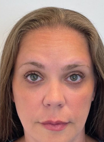 Houston Wellness & Aesthetics|Before and After Gallery