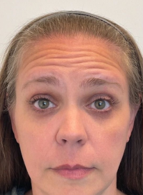 Houston Wellness & Aesthetics|Before and After Gallery