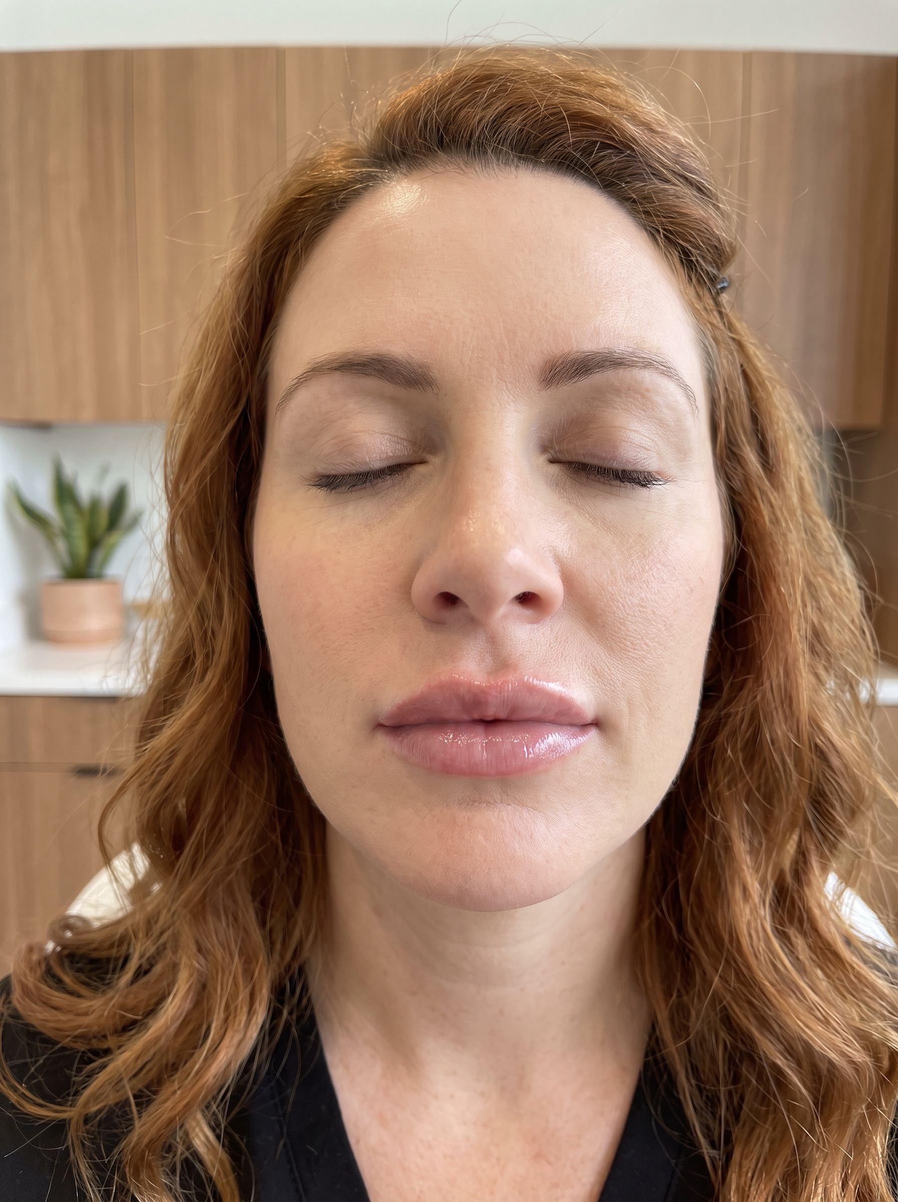 Soft, natural-looking lips after RHA lip filler at Houston Wellness & Aesthetics in Houston